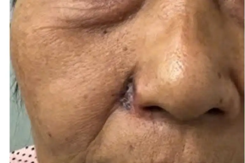 Kỳ Tích Y Học Việt Nam: Tái Tạo Hoàn Hảo Cánh Mũi Bị Ung Thư, Nâng Tầm Phẫu Thuật Tạo Hình