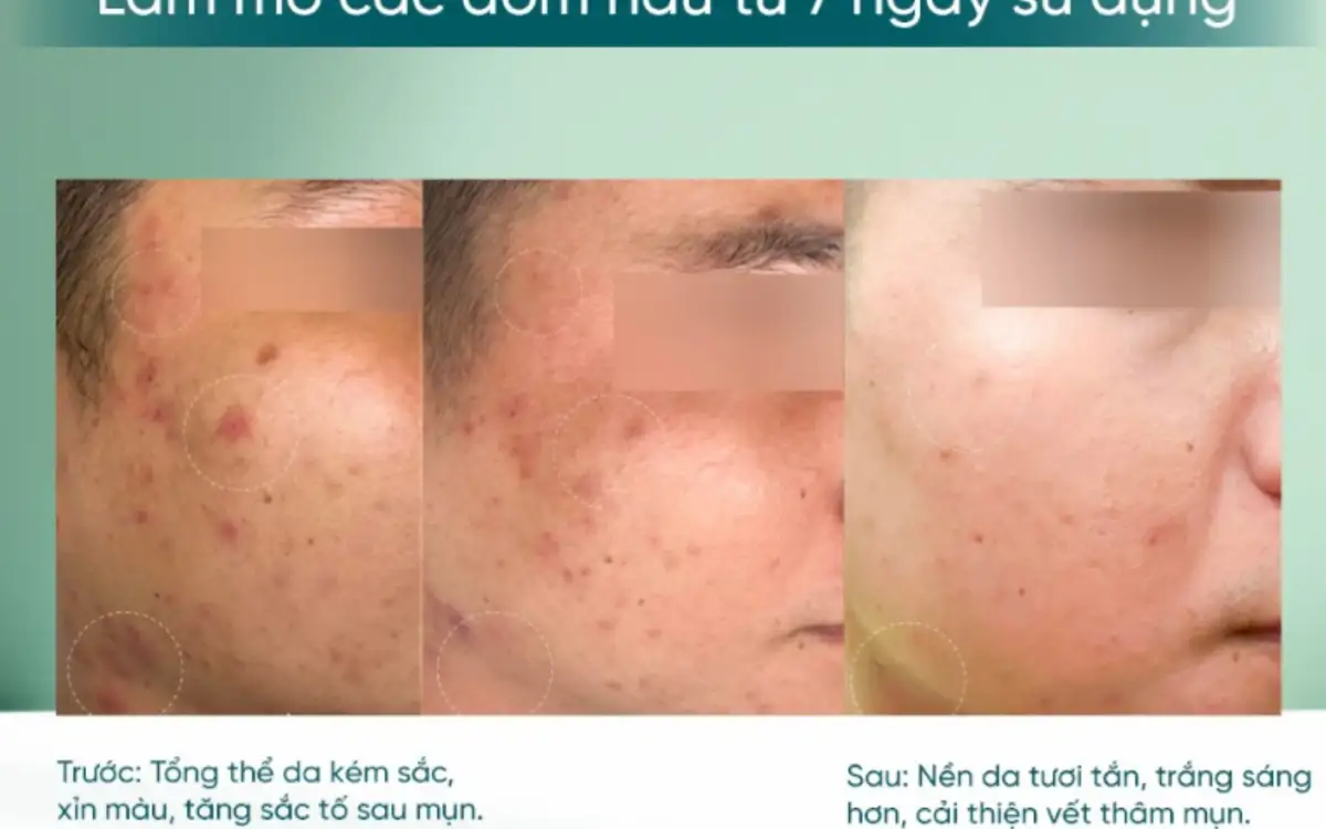 5 Serum Chống Lão Hóa Tốt Nhất: Cải Thiện Da Trắng Sáng, Mịn Màng