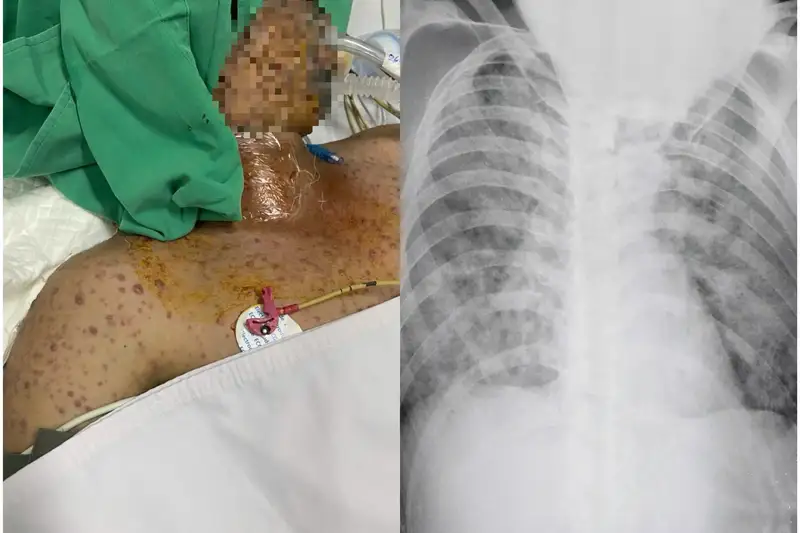 Người đàn ông nguy kịch vì thủy đậu: Hồi chuông cảnh tỉnh cho người lớn chưa tiêm vắc xin