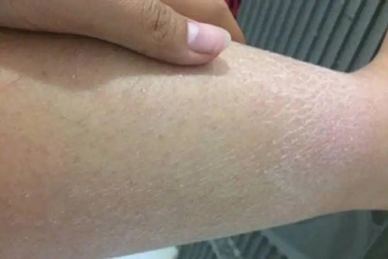 Chủ động siêu âm mạch máu chi dưới